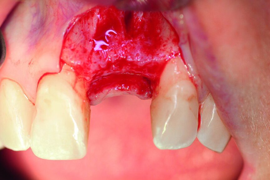 Fig. 4: The implant site was uncovered after five months.