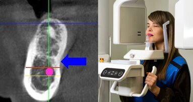 Risk of lingual concavity in implantology: CBCT correlates with inferior alveolar nerve canal