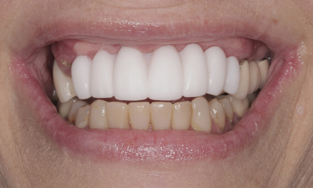Fig. 6b: High smile line without (a) and with the intra-oral mock-up (b).
