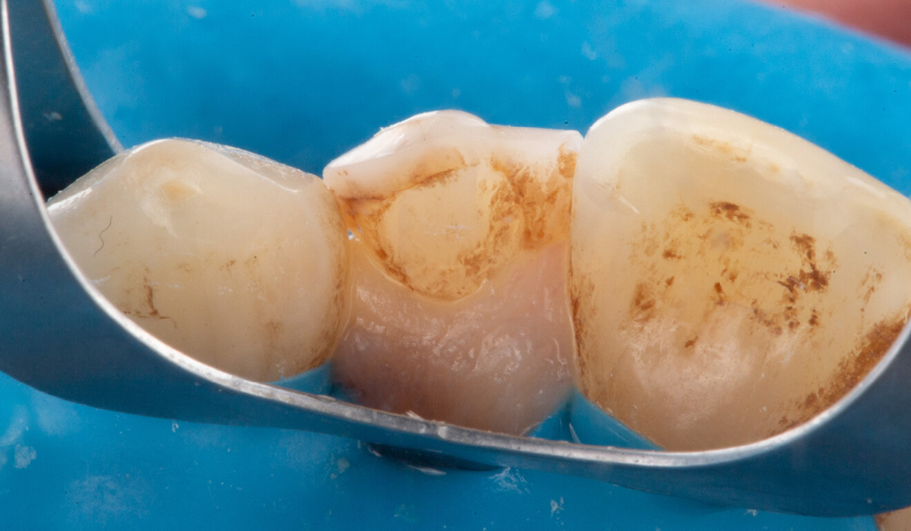 Fig. 2: Initial clinical situation. Palatal view of the existing restoration.