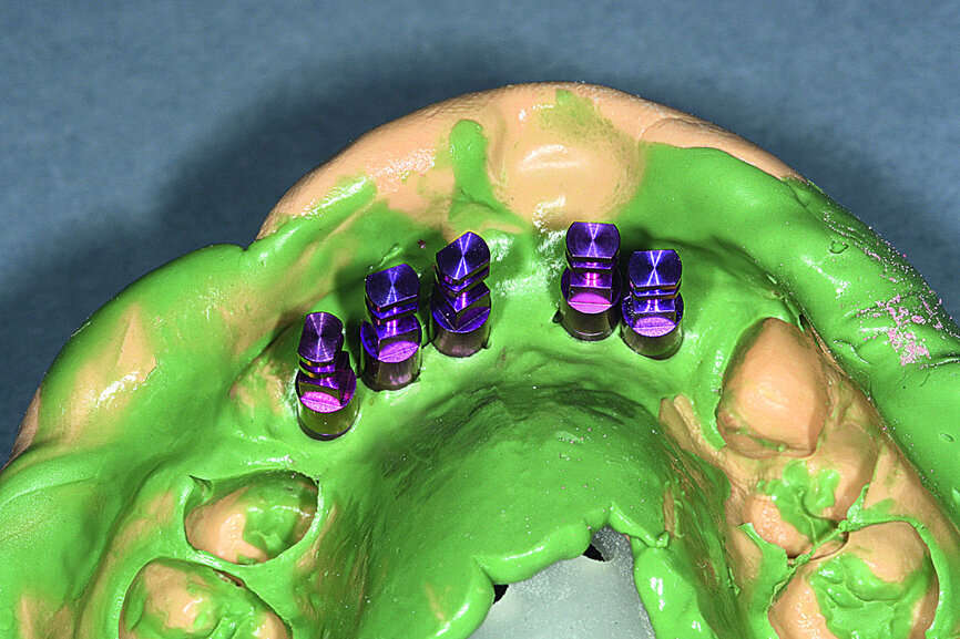 Fig. 20: Removal of the impression and fitting of the impression copings with their laboratory equivalent.