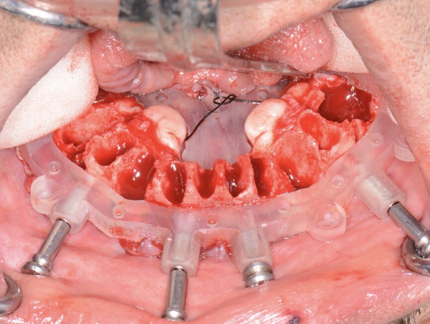 Fig. 16: Mandibular bone levelling guide.