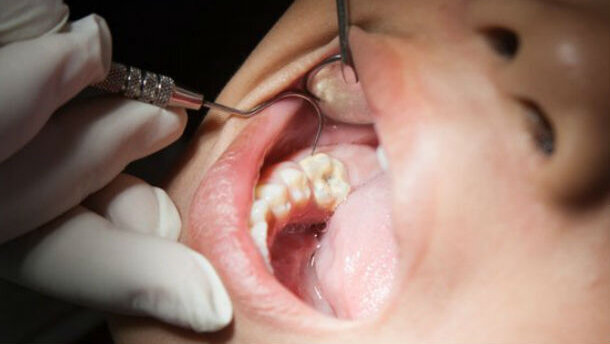 Individuati dalla ricerca vari trattamenti per la sigillatura dei denti