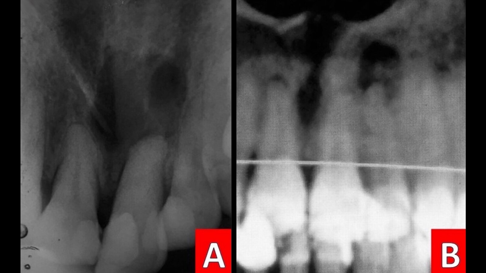 Tratamiento endoquirúrgico de periodontitis apical crónica y dientes supernumerarios