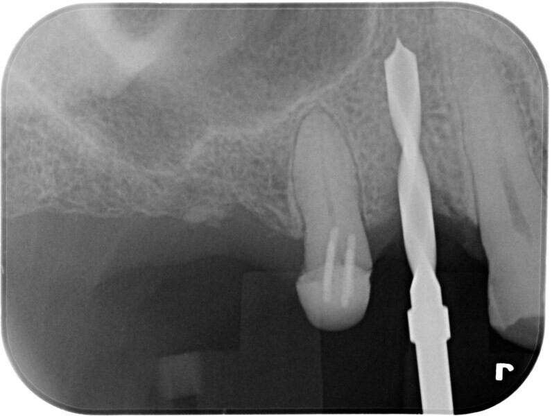 Fig. 16: Guided osteotomy.