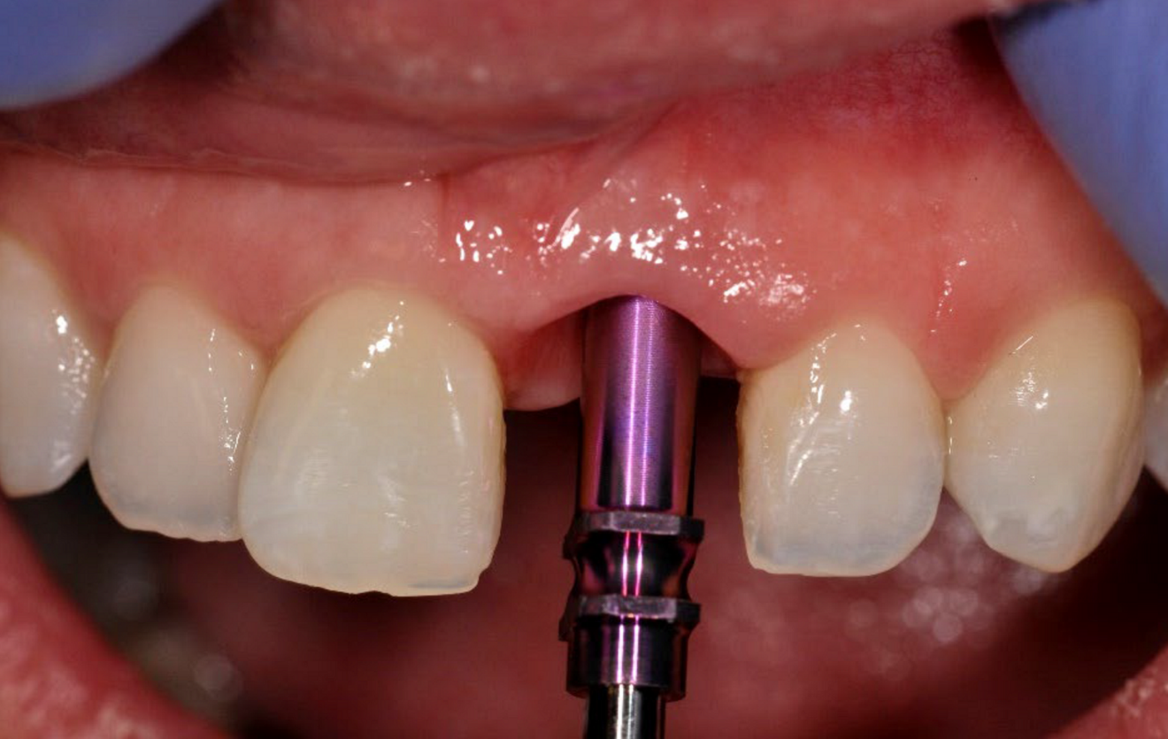 ...and clinical view at insertion of a narrow-platform 15 mm NobelActive implant (b).