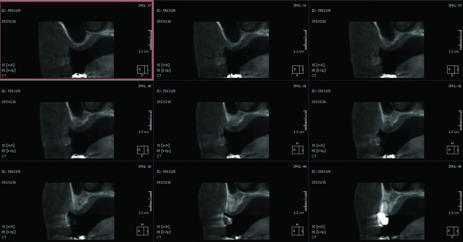 Fig. 1_CBCT preoperatoria: si noti la mancanza di osso necessario a stabilizzare due impianti.