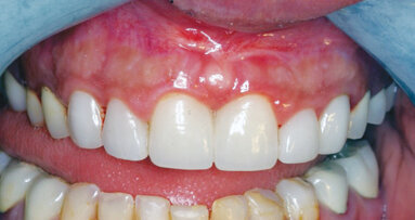 Unique maxillary frenectomy with a diode laser