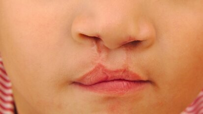 No link found between oral cleft surgery and cognitive impairment