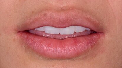 Realce de labios en la consulta odontológica