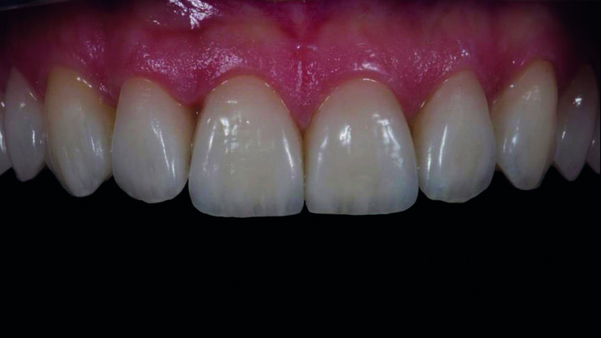 | Fig. 15a : Facettes en céramique feldspathique avec pâte d‘essai