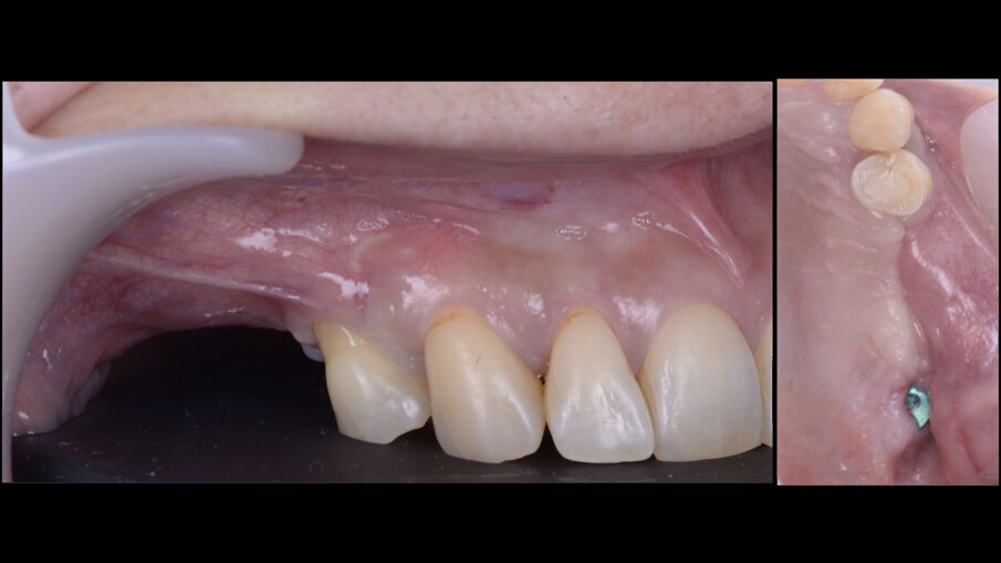 Fig. 1 - Visione clinica pre-operatoria.