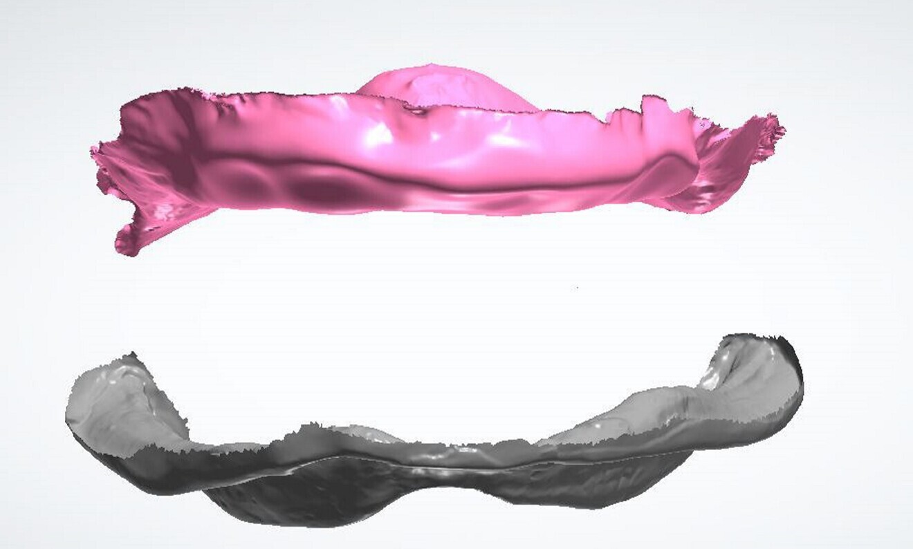 Fig. 5: Virtual removal of the maxillary prosthesis in exocad software. 