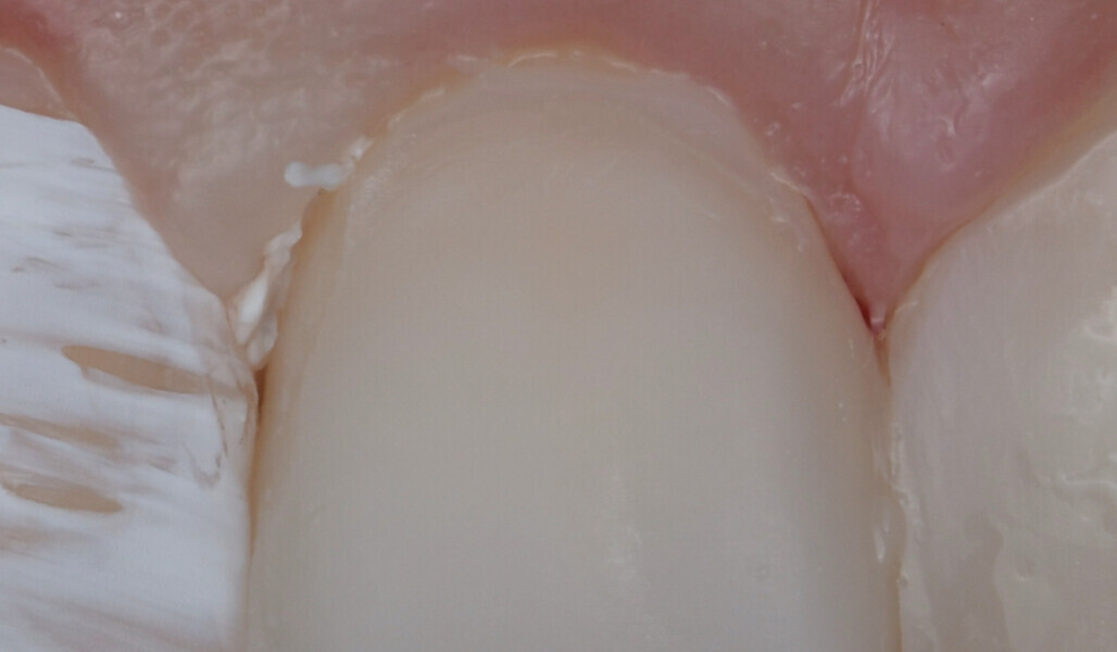 Fig. 10: Composite surface with a defect near the margin after thorough rinsing and drying.