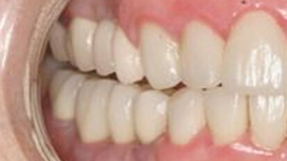 Soft-tissue collar around implants: A periodontal compromise or not?
