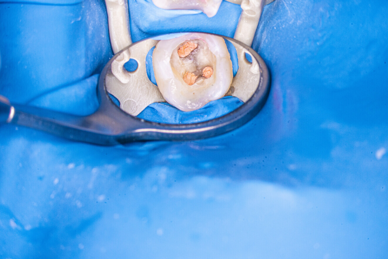 Fig. 9: Pulp chamber after obturation with the piston technique.