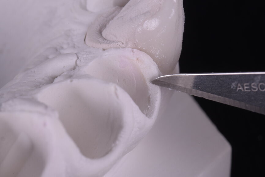 Fig. 66: Cervical contouring for the new cervical design.