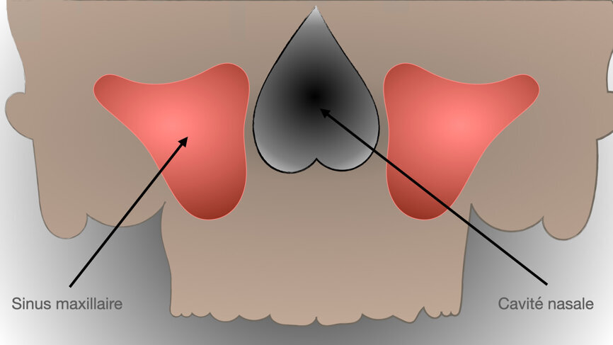 Fig. 1 : Obstacles anatomiques au maxillaire.