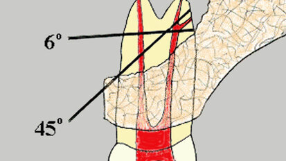 Apical microsurgery: the REB and REP (Part 4)