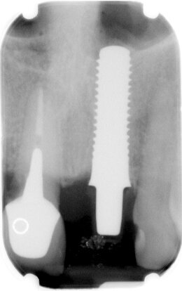 Fig. 8 - Visione radiografica seguente all’inserimento dell’impianto.