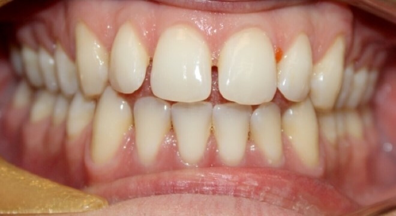 Fig. 4: Excessive spacing in a 29-year-old male patient.