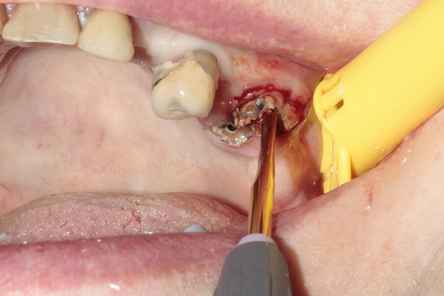 Fig. 3: The tooth was luxated with Luxator P4 (dual edge, lilac). 