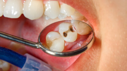 Human immune system contributes to dental caries and damage to dental fillings