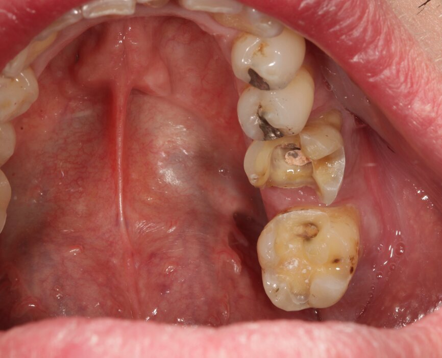 Fig. 3b: The
prepared teeth are readied for intraoral digitalisation (intraoral scanning).