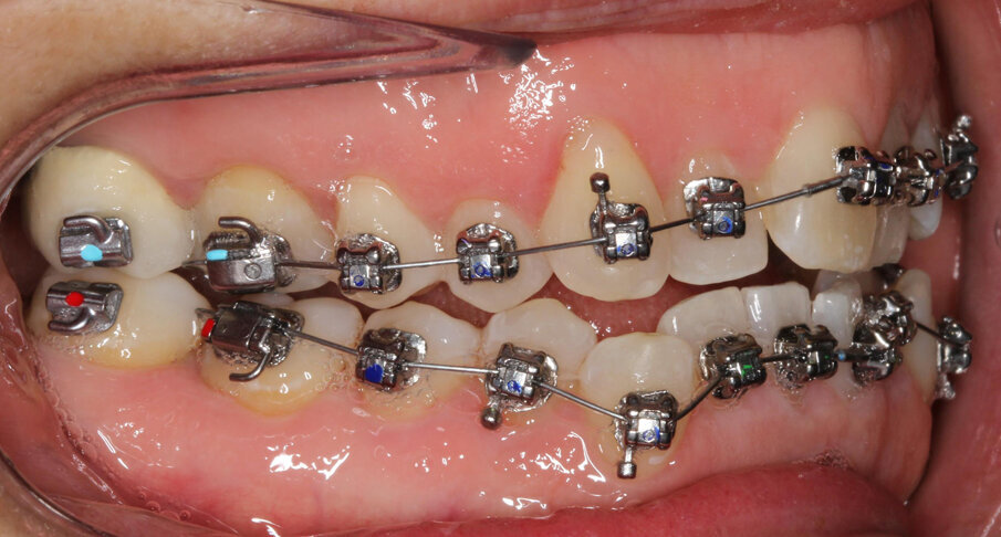 Initial treatment