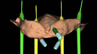 Mantenimento igienico delle protesi full-arch a supporto implantare con abutment a basso profilo