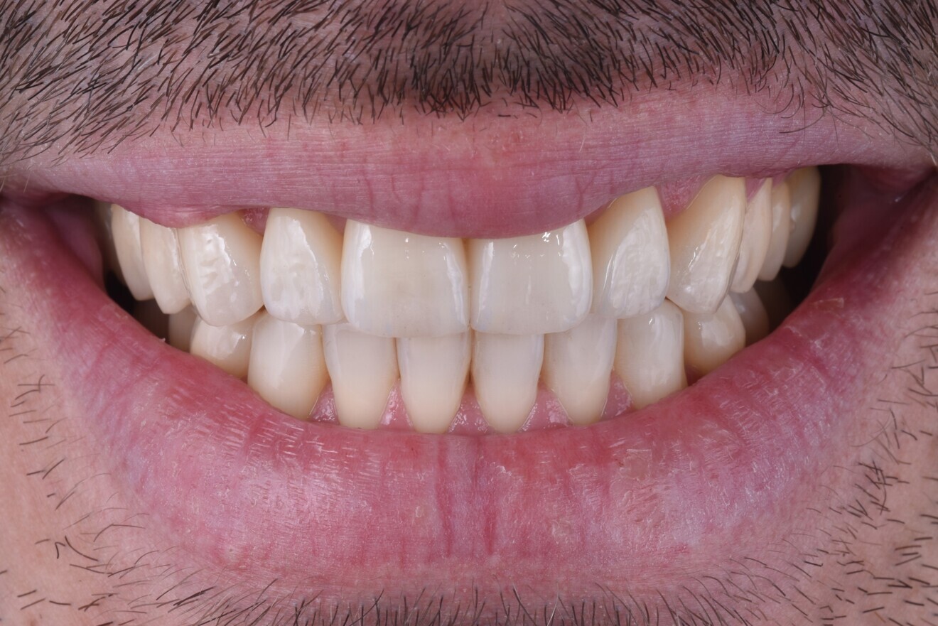 Fig. 16b: Final extra-oral photograph.