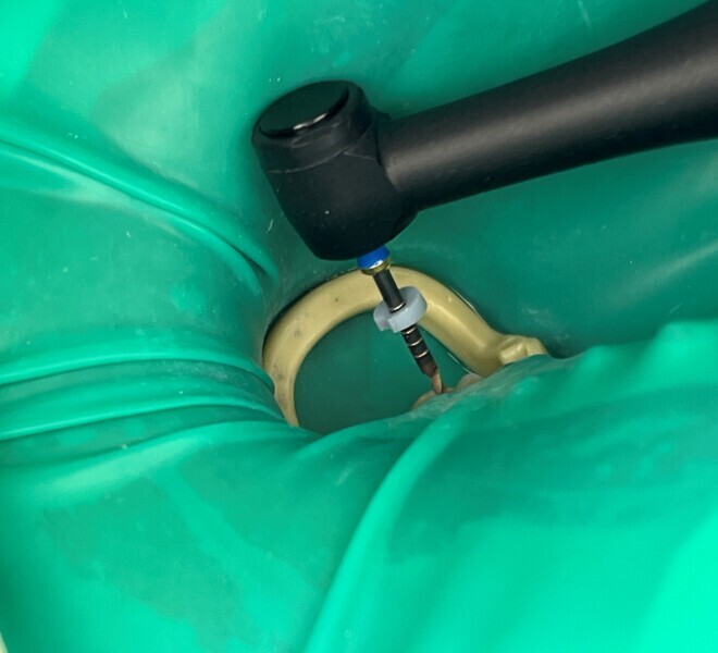Fig. 5: Preparation with the cordless CanalPro X-Move endodontic motor.