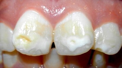 Colgate lanza un Advisory Board sobre mancha blanca en ortodoncia