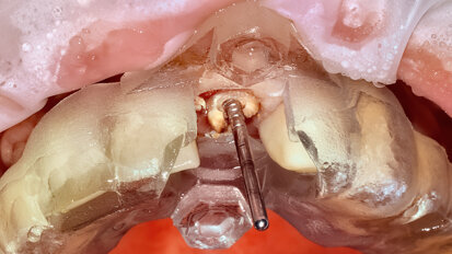 Guided applications for partial extraction therapy