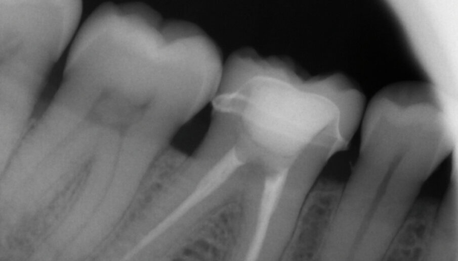 Fig. 13b: X-ray control image before and after the treatment