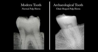 Scientists discover that dental radiographs can reveal vitamin D deficiency