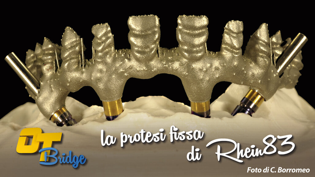 OT BRIDGE: la protesi fissa secondo la Rhein83