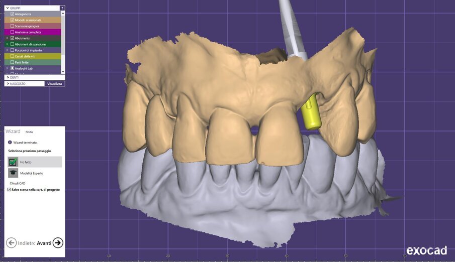 Fig. 13_Workflow digitale per la realizzazione della corona.