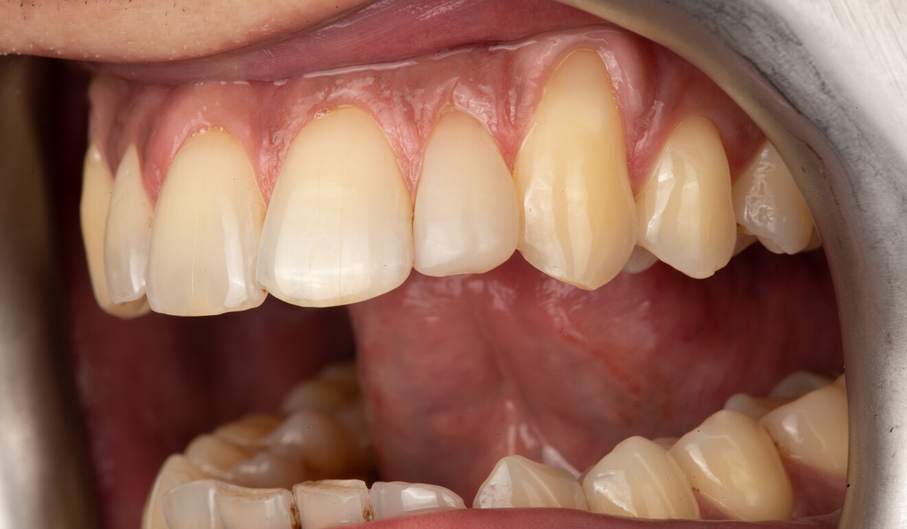 Fig. 10: Close-up of the restoration, confirming smooth optical integration.