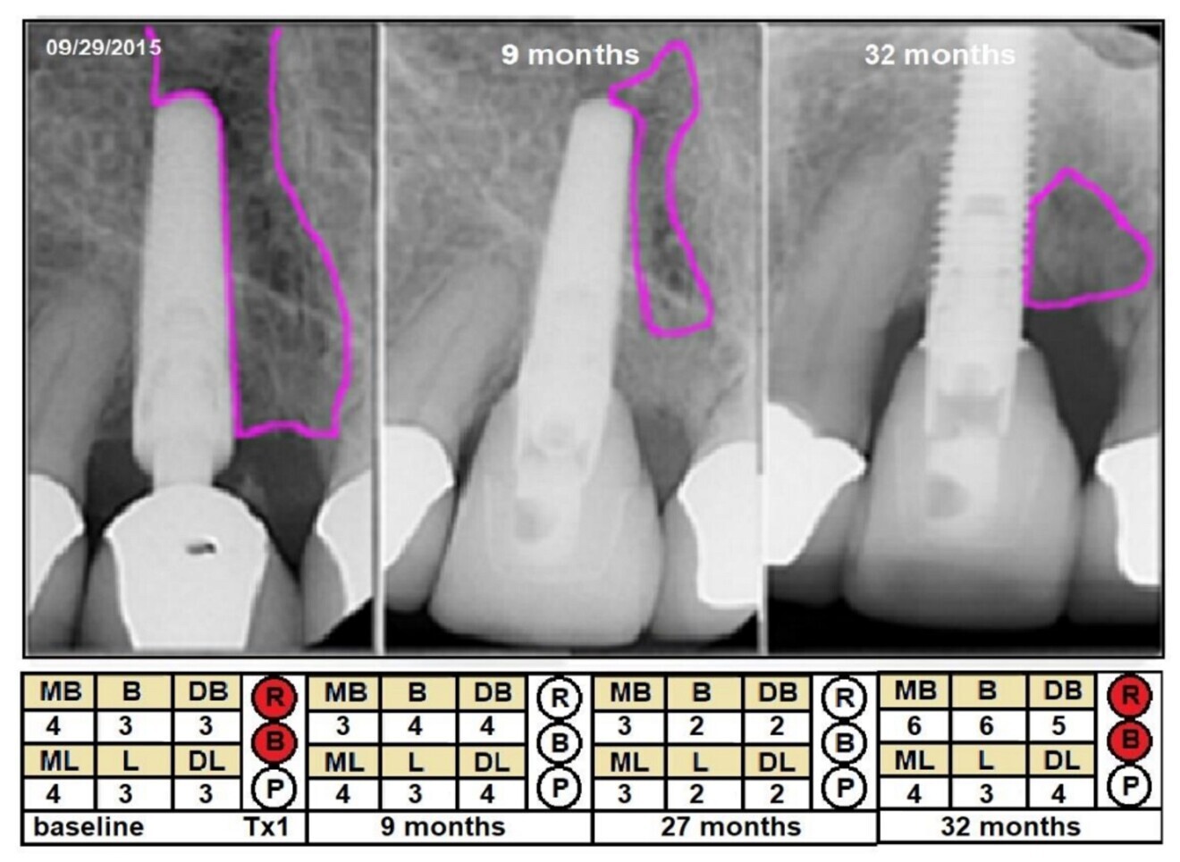 Fig. 4: Example of a successful single treatment that was without clinical signs for over two years, and then the implant presented with signs of reinfection (Case 3), showing changes in radiographic defect (mm2), probing depth (PD; mm) and clinical signs from baseline to 32 months later. Violet = cross-sectional area; MB = mesiobuccal PD; B = buccal PD; DB = distobuccal PD; ML = mesiolingual PD; L = lingual PD; DL = distolingual PD; R = redness; B = bleeding; P = suppuration; Tx1 = first treatment.