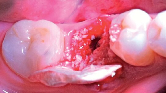 Rigenerazione dei tessuti molli perimplantari: case report