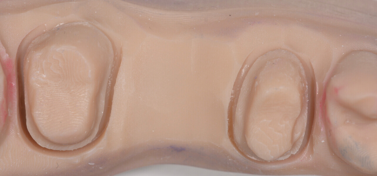 Figs. 4a–d: 3D-printed models with the new layered zirconia bridge.