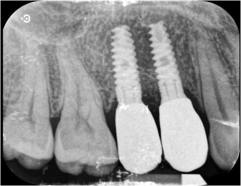 Fig. 12-14_Corone definitive e rx di controllo a due anni dalla chirurgia.