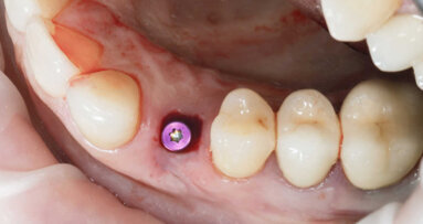 Nanotecnologia pode melhorar a integração de tecidos moles de implantes dentários