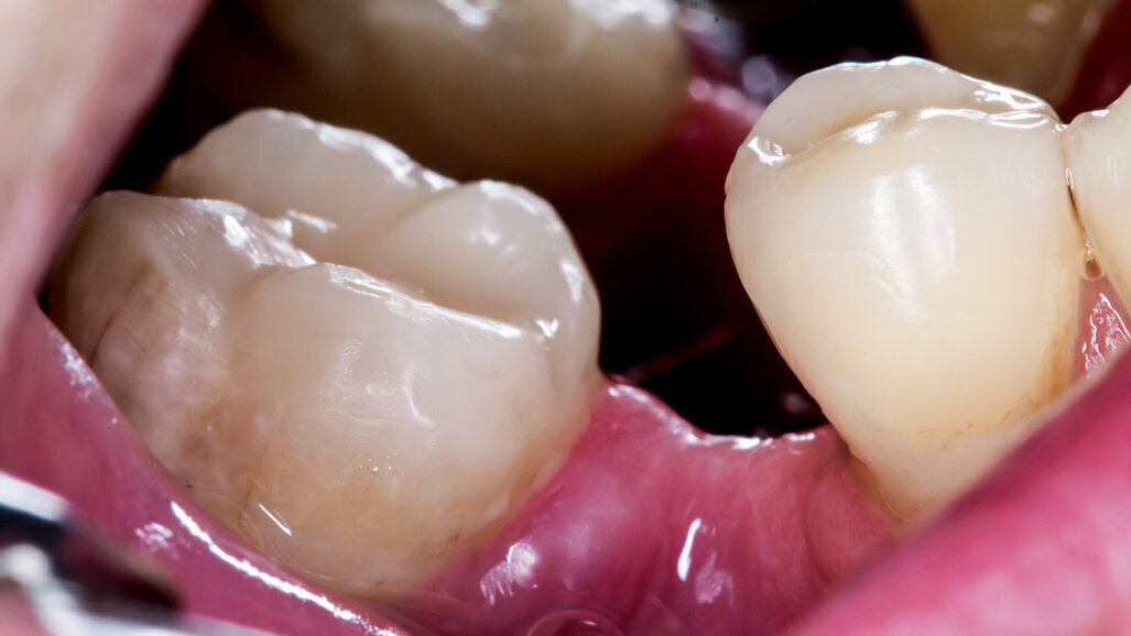 Growing new teeth: Researchers pursue “every dentist’s dream”