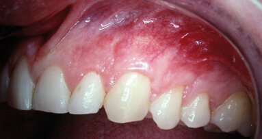Using resorbable barriers to make root recession coverage predictable