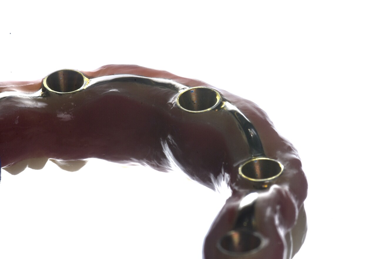 Figs. 16a–c: Definitive monolithic zirconia prothesis bonded to the anodised titanium bar (a–c).
