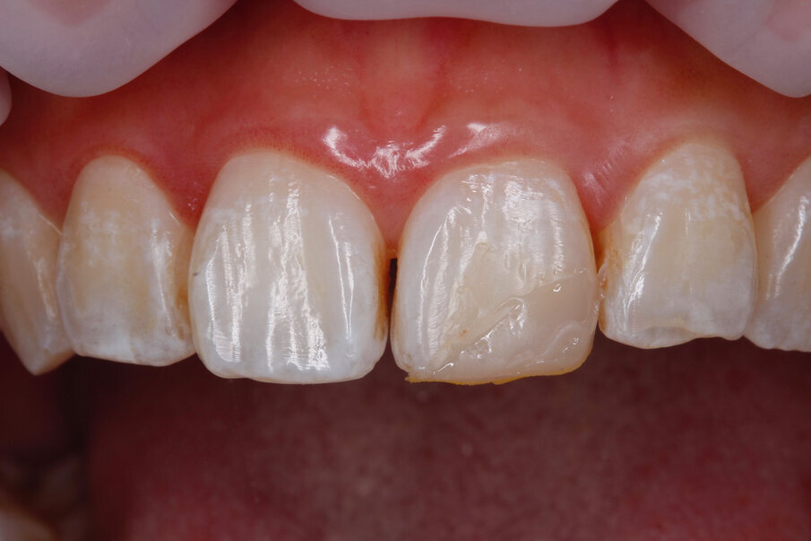 Fig 3: Build-up of composite to prepare the putty index