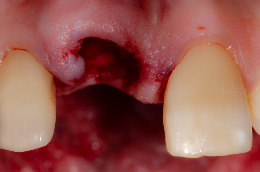 Fig. 12a: After extraction of tooth #11, anterioR view.