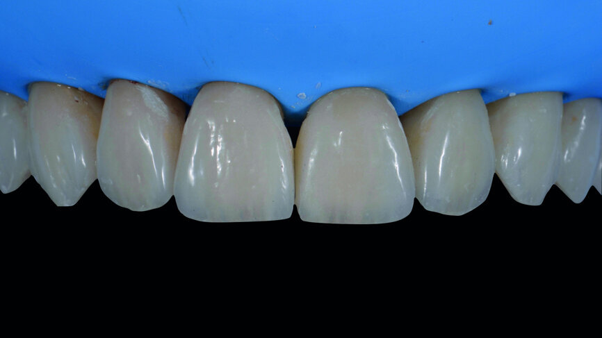 Fig. 16e: Veneers in situ before finishing and polishing procedures.